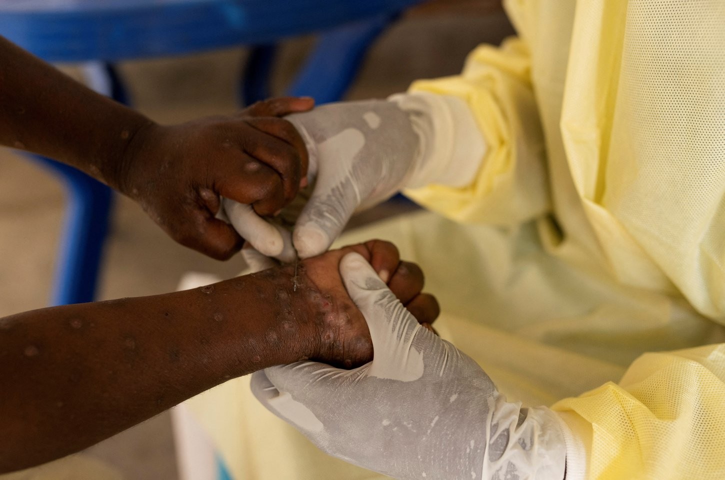 Brasil registra 88 casos de Mpox em 2025, com predominância em São Paulo