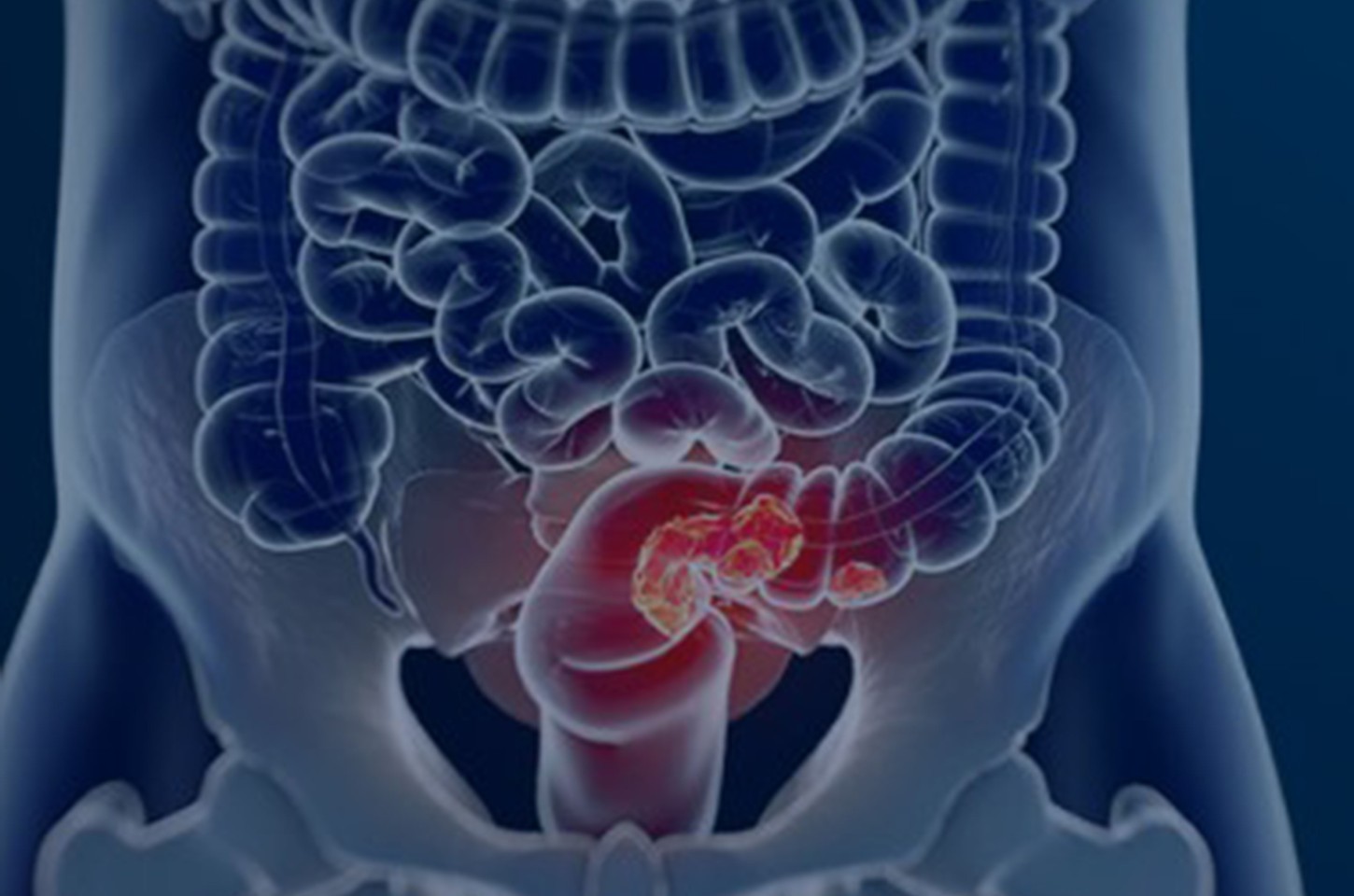 Câncer colorretal é diagnosticado tardiamente em mais de 60% dos casos no Brasil