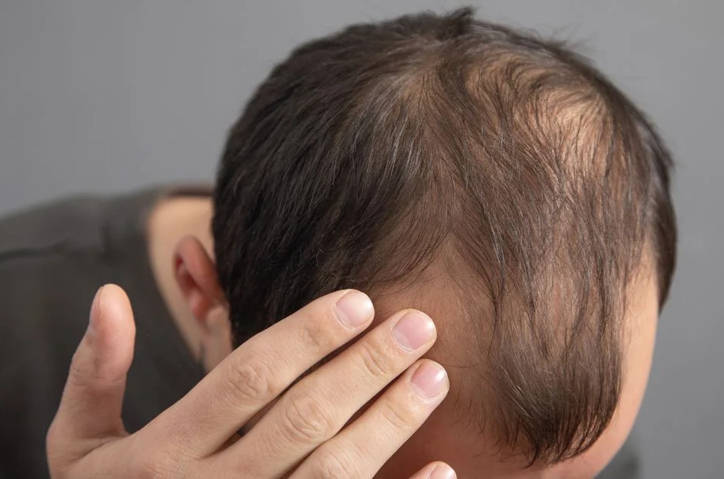 MyHair AI: Como uma experiência pessoal inspirou startup que usa IA contra calvície